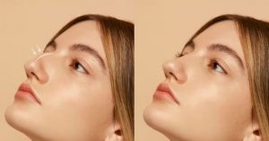 How Can You Have Straight Nose Without Surgery?